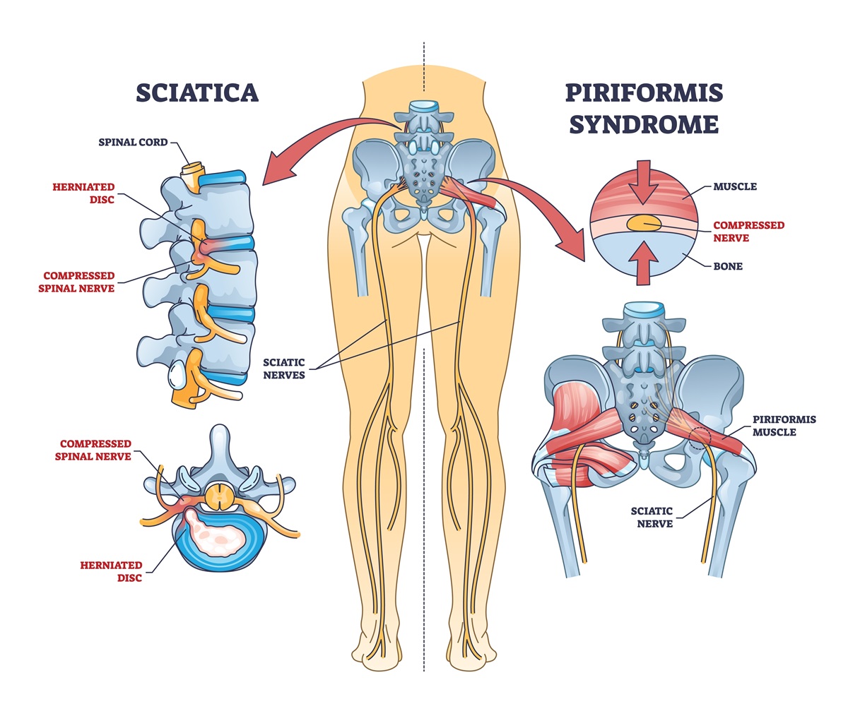 Ischias a Piriformis syndróm - rozdiel v príčine vzniku